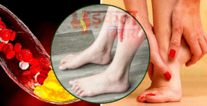 हाई कोलेस्ट्रोल के पैरों में दिखने वाले लक्षण:&hellip;