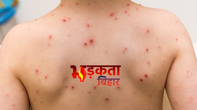 पटना के नौबतपुर में चिकन पॉक्स का कहर, एक हफ्ते में 50 लोग बीमार, बच्चों में ज्यादा संक्रमण