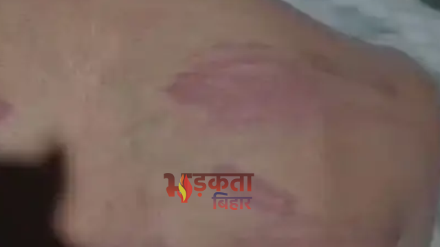 Bihar News: वैशाली में बेल तोड़ने के आरोप में 12 वर्षीय छात्र की बेरहमी से पिटाई, एक आरोपी गिरफ्तार